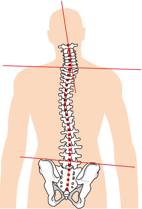 背骨の椎間板の状態